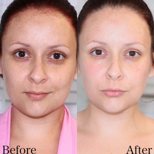 Chemical peels Pictures