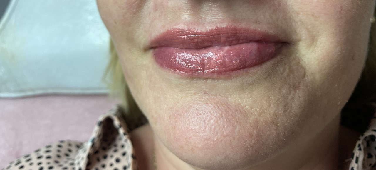 Lip Filler