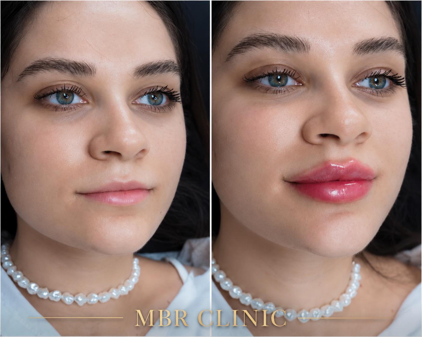 Russian Lip Filler