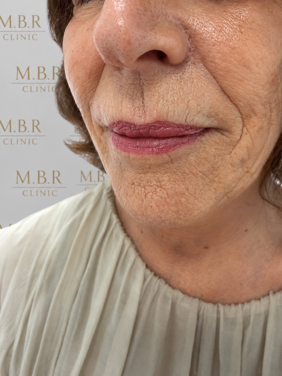 Before Face Filler