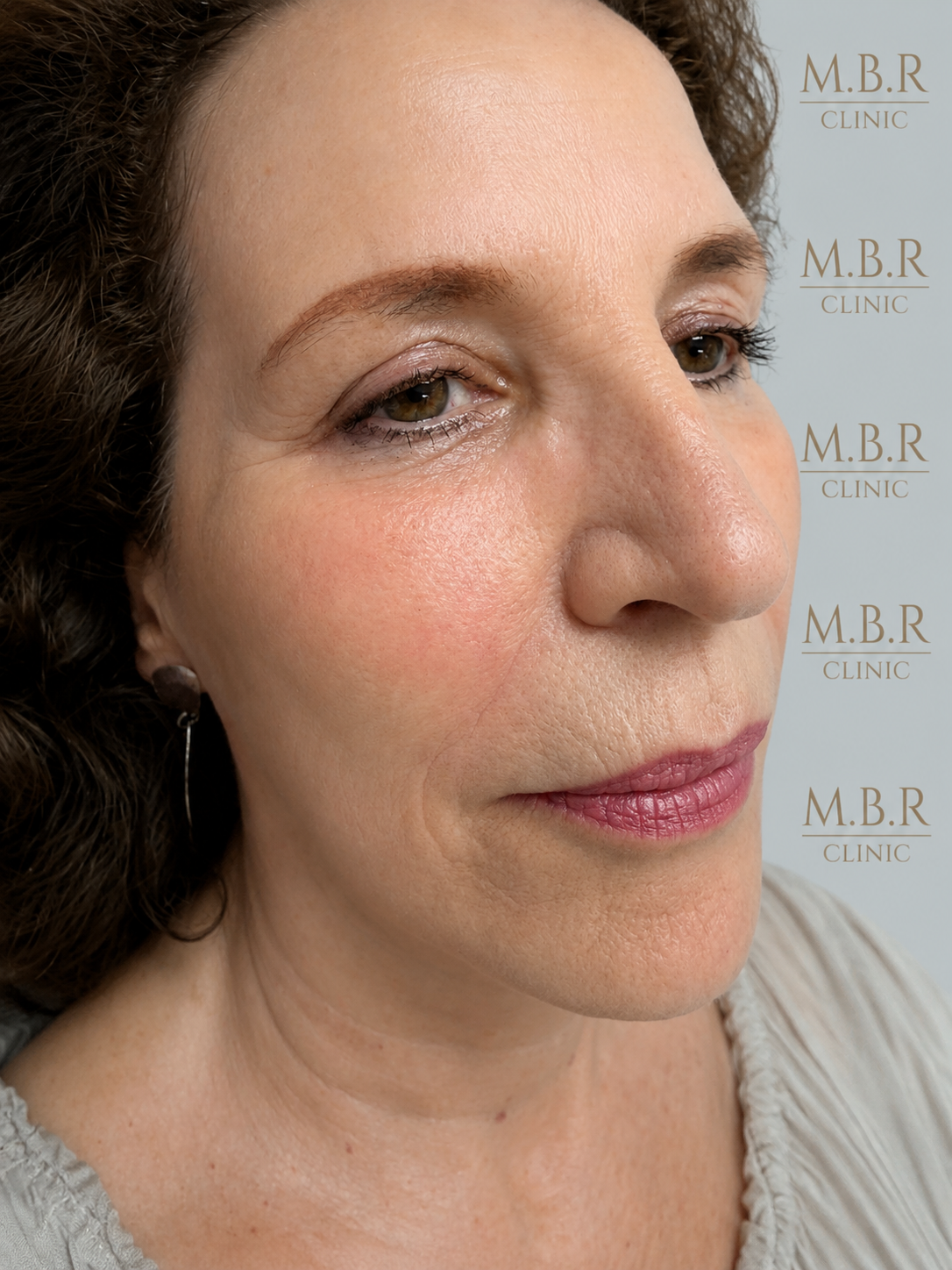 After treatment result