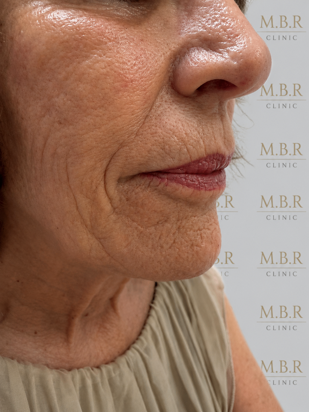 Before treatment