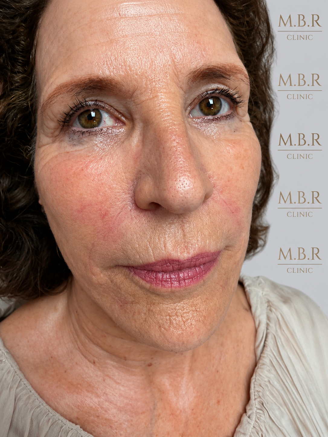 dermal filler 3 ml only