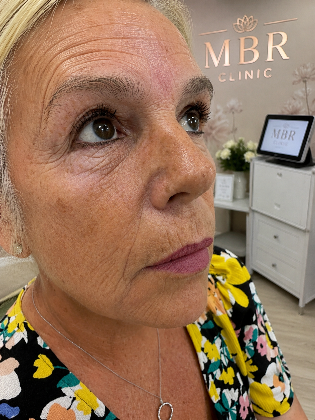 Before treatment