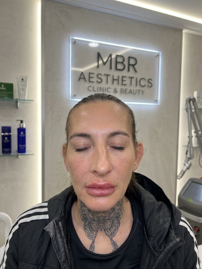 1 ml lip filler
