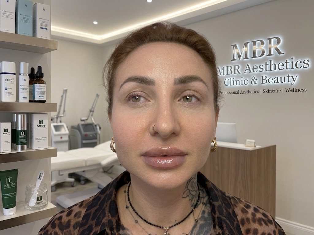 Lip filler 1 ml